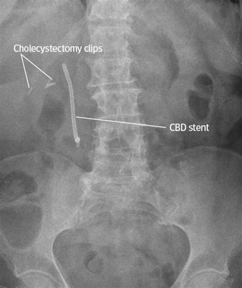 Interpreting lines and tubes on radiographs | The BMJ