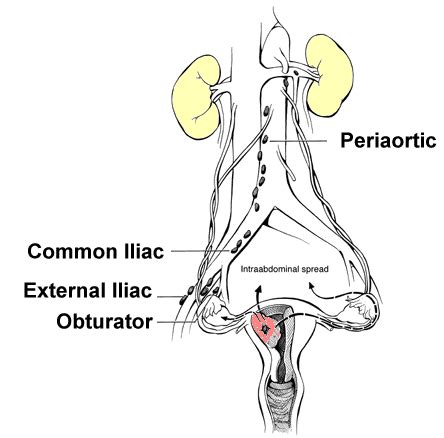 Para Aortic Lymph Nodes Treatment