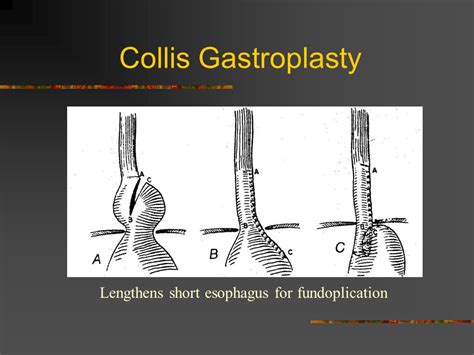 Collis Gastroplasty