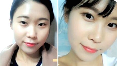 KOREAN DOUBLE EYELID SURGERY BEFORE AFTER - YouTube