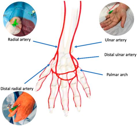 JCM | Free Full-Text | Radial Artery Access for Percutaneous ...