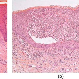 (PDF) An update on generalized pustular psoriasis