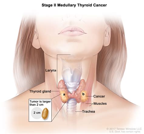 Thyroid Cancer Treatment (PDQ®)–Patient Version - NCI