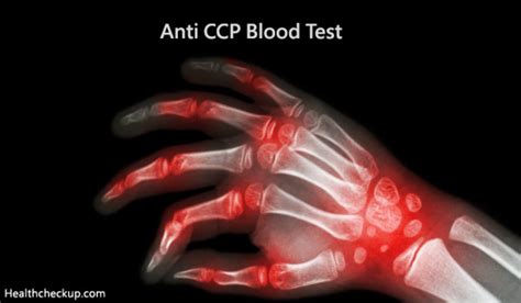 Anti-CCP Blood Test -Purpose, Procedure, Results and Normal Range by Dr Ahmed