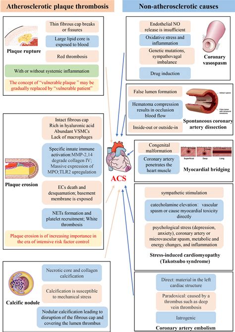 New Concepts on the Pathophysiology of Acute Coronary Syndrome