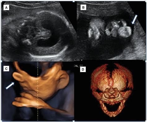 Figure 1 from Prenatal diagnosis of holoprosencephaly with proboscis and cyclopia caused by ...