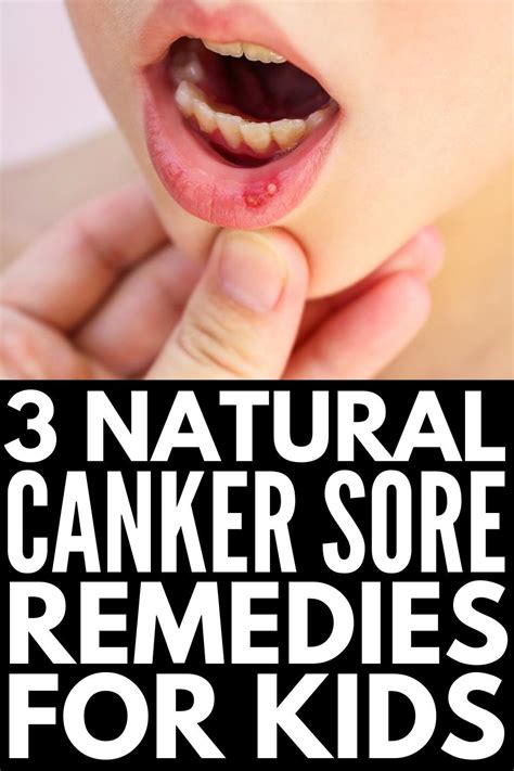 Natural and Effective: 9 Canker Sore Remedies That Work Fast