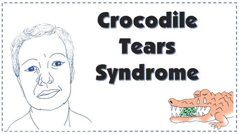 Crocodile Tears | Bogorad Syndrome| Explained - YouTube