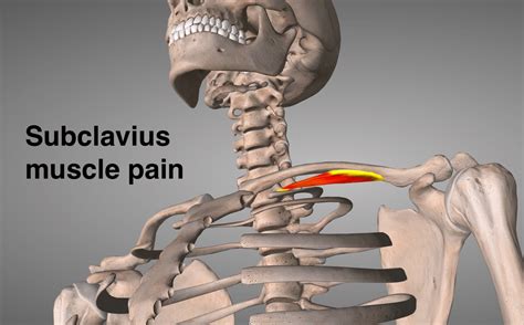 Subclavius Muscle Pain - Muscle Pain