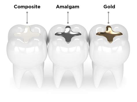 Dental Fillings, Composite Restorations, Cavity Filled in Sparta, NC