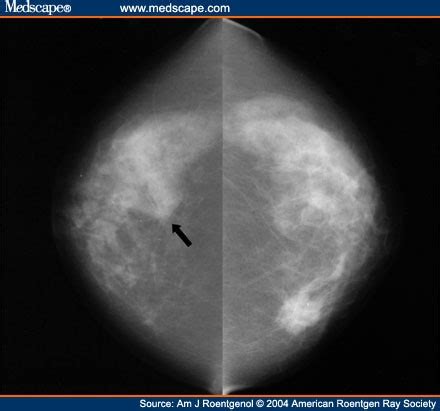 Mammography: August 2015