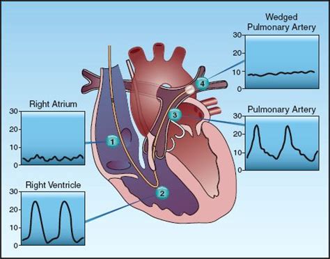 Pulmonary Artery Catheter Waveforms