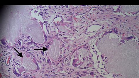 Cureus | Ulcerated Tophaceous Gout