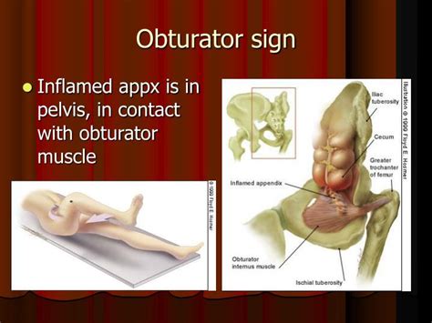 PPT - Appendicitis PowerPoint Presentation - ID:6769039