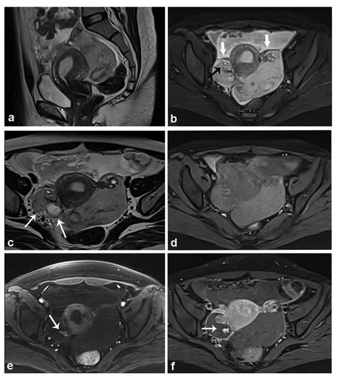 (a) Anteverted, retroflexed uterus is seen with empty cavity; (b) T2 ...