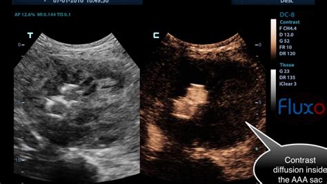 Endoleak type II - CEUS - Contrast Enhanced ultrasound - YouTube