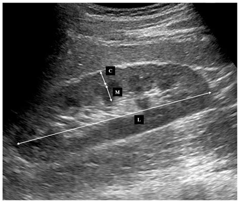 Normal Renal Ultrasound