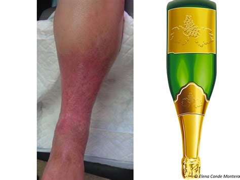 Chronic venous insufficiency from a dermatological perspective - Elena Conde