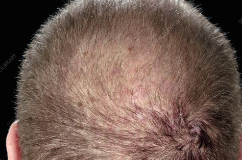 Folliculitis of the scalp - Stock Image - C025/8048 - Science Photo Library