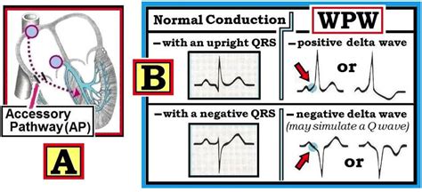 ECG Interpretation: ECG Blog #153 (LVH – RVH – WPW – RBBB)