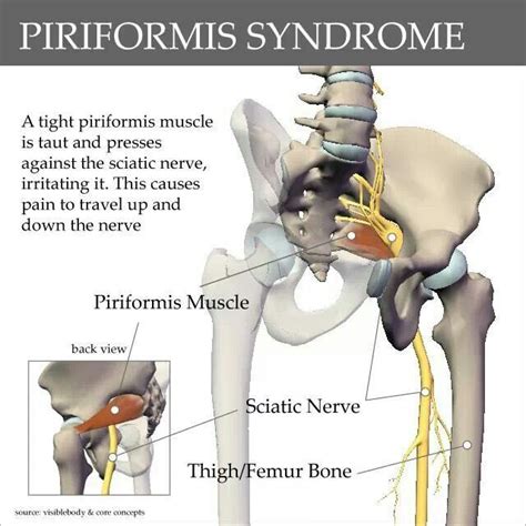 Piriformis Syndrome... Sciatica Pain Relief, Sciatic Pain, Sciatic ...