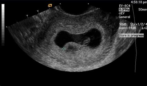 Subchorionic hemorrhage - wikidoc