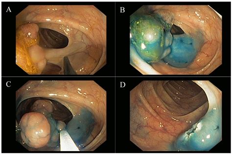 Malignant Colorectal Polyps: Diagnosis, Treatment and Prognosis | IntechOpen