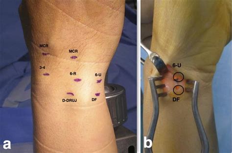 Arthroscopic Wrist Anatomy and Setup | Musculoskeletal Key