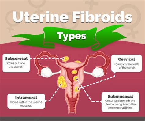 New Fibroid Treatment 2025 - Danna Elfreda