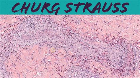 Churg-Strauss syndrome (eosinophilic granulomatosis with polyangiitis EGPA vasculitis) pathology ...