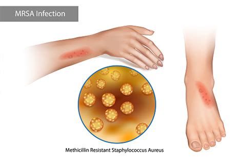 Vetores de Infecção Por Superinsetos Mrsa Staphylococcus Aureus Resistente À Meticilina Erupções ...