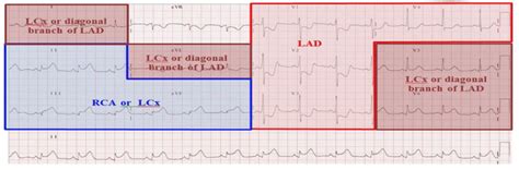 ECG of the Week – 3rd February 2021 – Interpretation | Emergucate