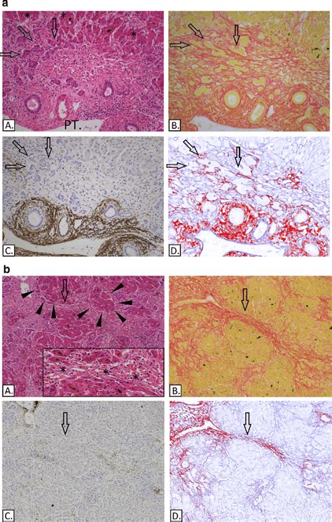 (a) Submassive hepatic necrosis. (A) H&E, a portal tract (PT) is shown... | Download Scientific ...