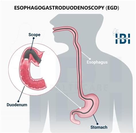 EGD | Upper GI Endoscopy - Gastrointestinal Tract Examination