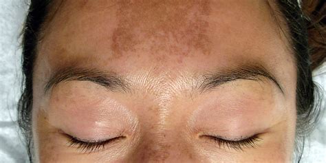 melasma 3 | Skinsmart | Dermatologist recommended, professional ...