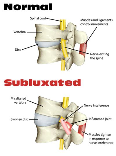 Causes of Subluxation - North Shore Chiro