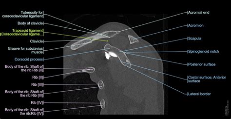 CT arthrogram of the shoulder joint: normal anatomy | e-Anatomy