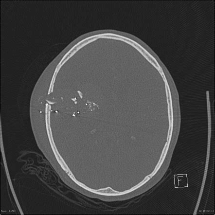 Investigating head injury (summary) | Radiology Reference Article | Radiopaedia.org
