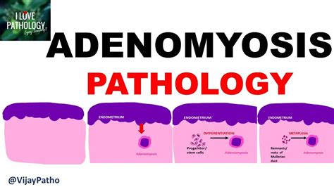 ADENOMYOSIS : Pathology, Clinical Features, Diagnosis & treatment - YouTube