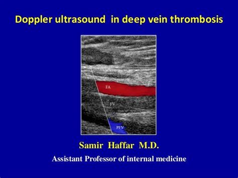 Doppler ultrasound in deep vein thrombosis