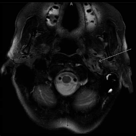 MRI brain with gadolinium contrast; fast spin-echo fat-suppressed T2 ...