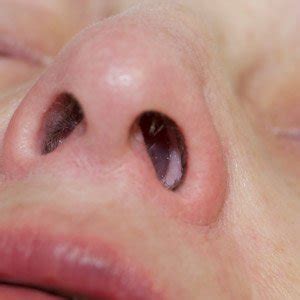 Nasal Polyps - Michigan ENT & Allergy Specialists