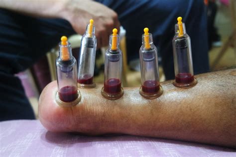 Ventosa cupping therapy - blood sucking massage