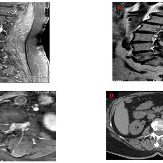 (PDF) Lumbar Spinal Angiolipoma with Expanding Left Neural Foramen ...