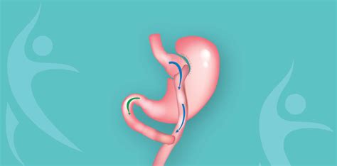 Secure Gastric bypass surgery in Tijuana at #1 Bariatric Clinic