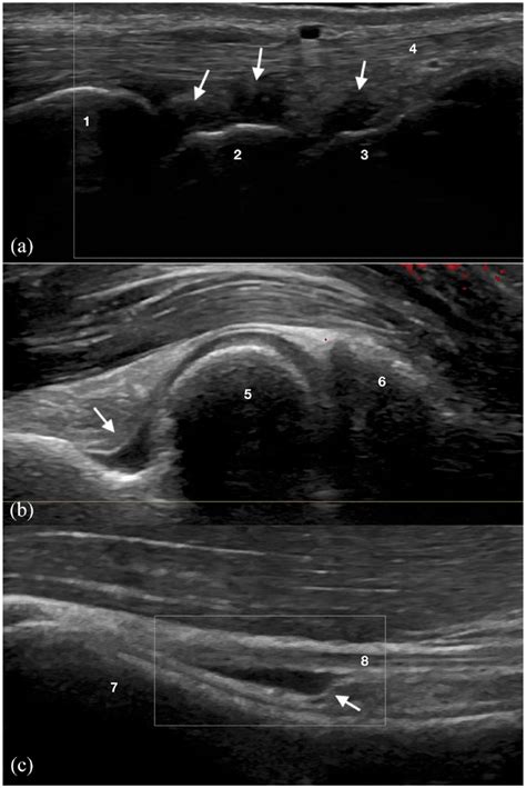 Ultrasound images of common joint and tendon effusions. Ultrasound... | Download Scientific Diagram