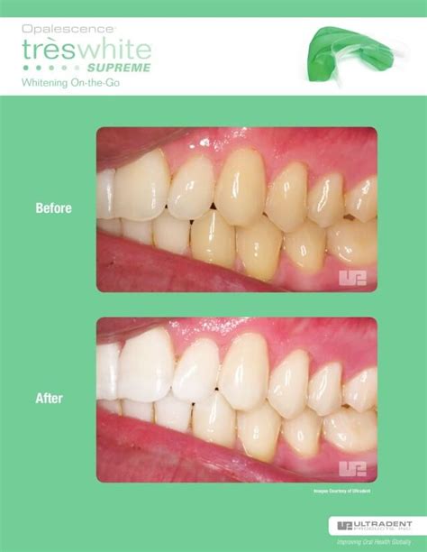 Teeth Whitening - Renaissance Dental Studio