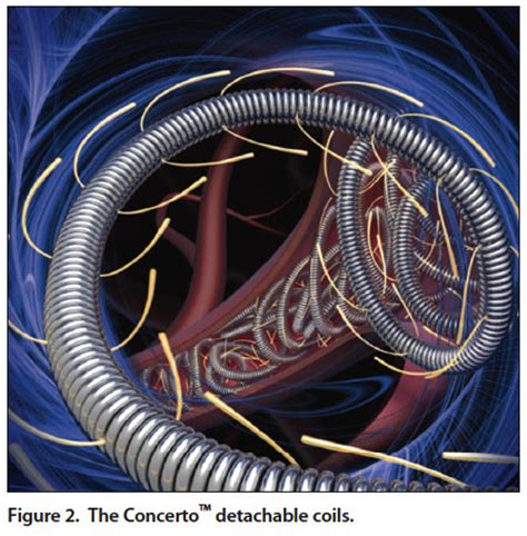 Endovascular Today - A New Era in Embolic Devices (October 2015)