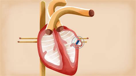 Watchman implant | Treatments | UW Health