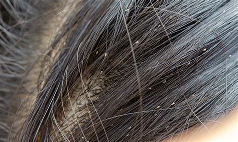 How To Get Rid Of Hair Lice - Birthrepresentative14